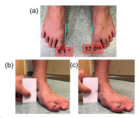 navicular drops in feet